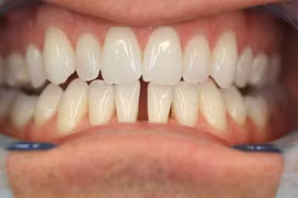 Những tướng răng vất vả, thị phi đeo bám