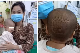 5 giờ phẫu thuật căng thẳng lấy khối u màng não ở vị trí hiểm cứu bé 2 tuổi