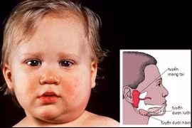 Những lưu ý nhằm phòng biến chứng của bệnh quai bị ở trẻ nhỏ
