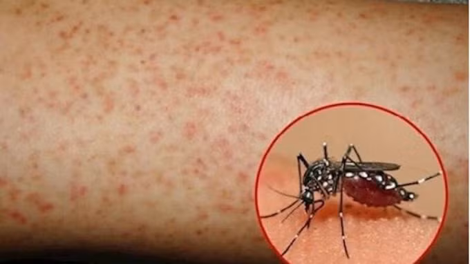 Tác nhân trung gian truyền bệnh sốt xuất huyết là các loại muỗi