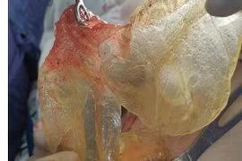 Vỡ túi nâng ngực, khi phẫu thuật đã phát hiện khối u