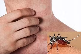 Việt Nam có số ca mắc sốt xuất huyết thuộc nhóm cao nhất Đông Nam Á