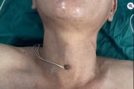 Bị đinh thép đâm xuyên cổ, bệnh nhân thoát chết ngoạn mục nhờ xử trí kịp thời