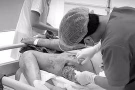 Từ nốt mụn nhỏ ở mông, bệnh nhân 76 tuổi suýt mất mạng vì nhiễm tụ cầu vàng 'siêu kháng thuốc'