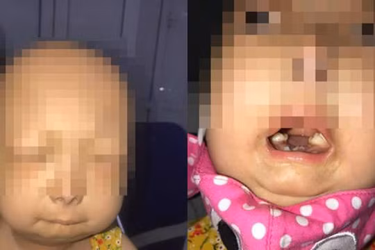 Phát hiện bé gái mắc hội chứng "con báo" đầu tiên tại Việt Nam