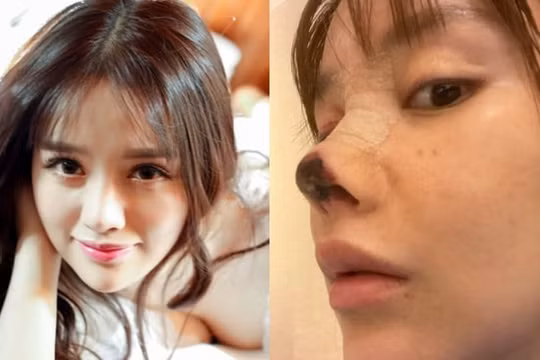 Những 'bi kịch' phẫu thuật thẩm mỹ của sao Hoa ngữ