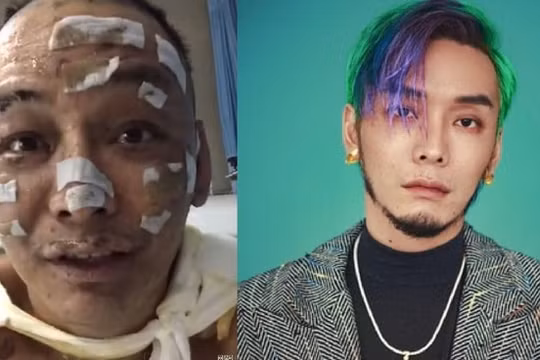 Nam rapper Từ Chân Chân bị bỏng nặng, mặt biến dạng