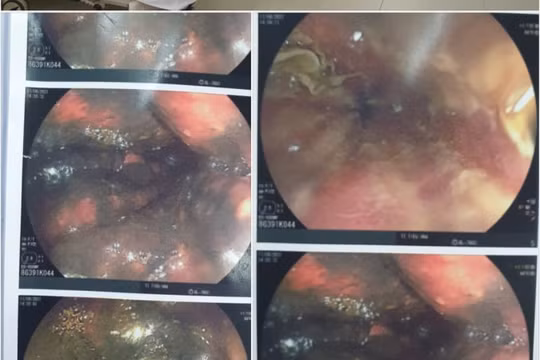 Uống nước tẩy rửa bồn cầu, đường tiêu hóa của một bệnh nhân bị phá hủy trầm trọng