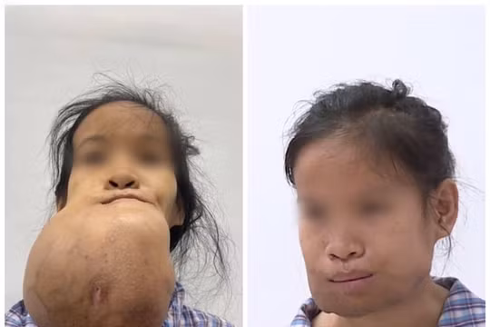 Cô gái 24 tuổi khuôn mặt bị biến dạng vì khối u khổng lồ