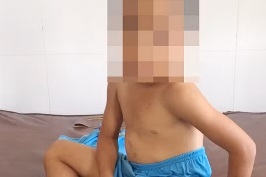 Sóc Trăng: Bé trai 6 tuổi bị cha dượng bạo hành dã man