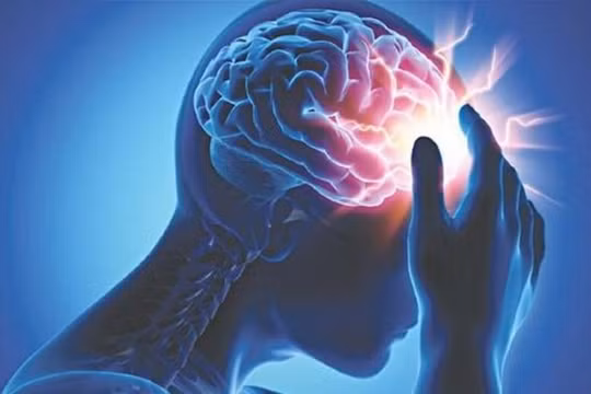 Những dấu hiệu sắp đột quỵ bạn nên biết