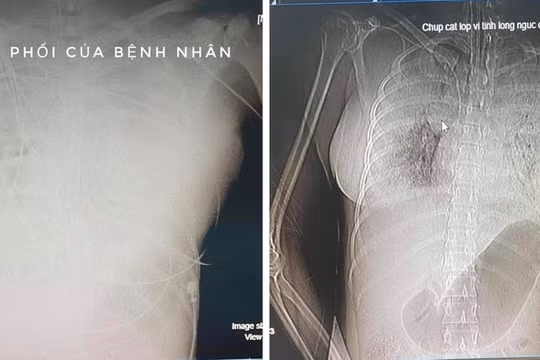 TP. HCM: Một phụ nữ tử vong sau một tuần tiêm filler nâng ngực
