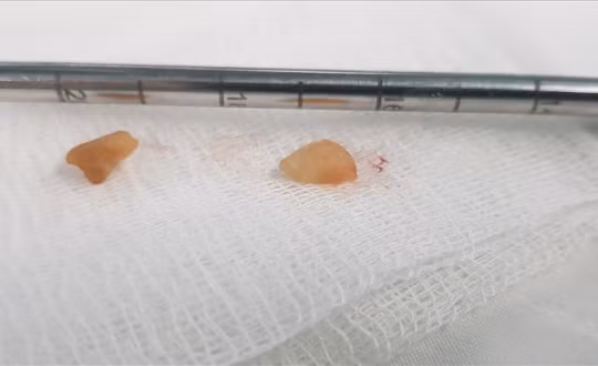 Phẫu thuật cứu sống bé trai 2 tuổi bị hóc hạt đậu phộng khi ăn xôi