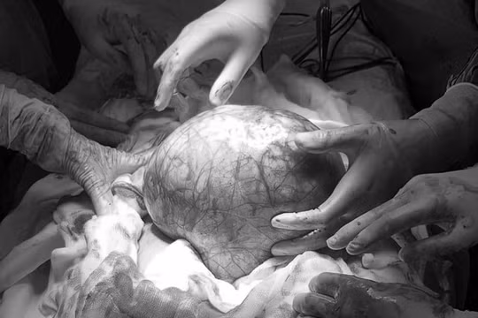 Người đàn ông dính u 3,5 kg sau khi uống thực phẩm chức năng chợ trời