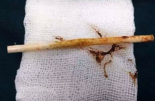 Que nhựa dài 10cm mắc kẹt hơn 1 tháng trong bụng bé trai 3 tuổi