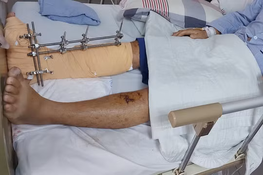 Cứu người đàn ông bị dập cẳng chân do tai nạn giao thông