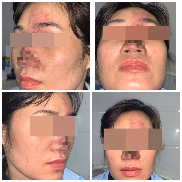 Bệnh nhân hoại tử mũi sau khi tiêm filler làm đẹp. Ảnh: doisongvietnam.vn
