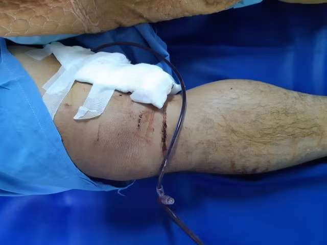 Vết thương đùi phải sau mổ. Ảnh: dantri.com.vn