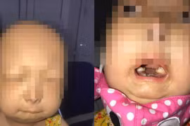 Phát hiện bé gái mắc hội chứng "con báo" đầu tiên tại Việt Nam