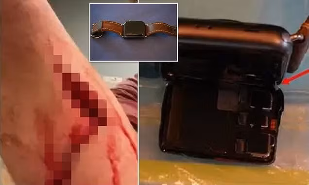 apple bi kien vi dong ho apple watch gay thuong tich cho nguoi dung hinh 1