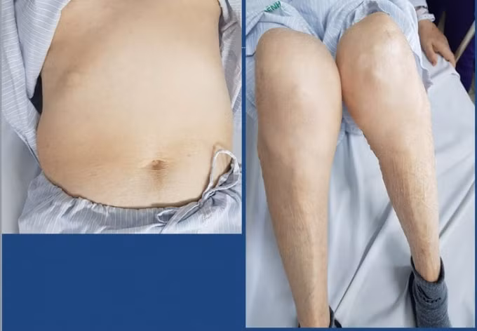 Bệnh nhân bị teo cơ, trướng bụng vì lạm dụng corticoid (ảnh TL).