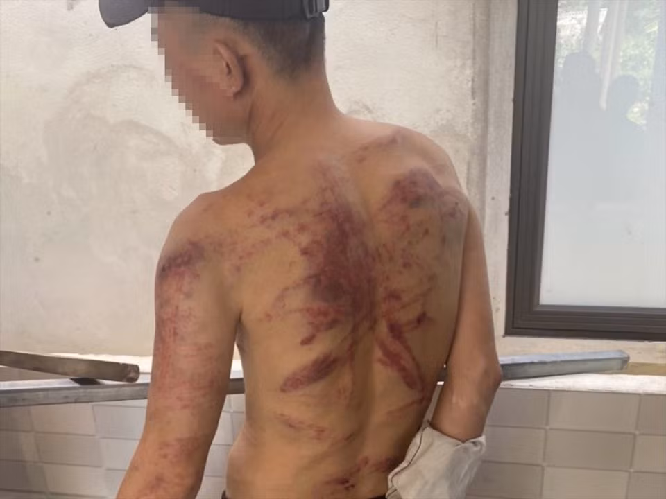 Nạn nhân H. bị chủ nợ đánh thương tích.