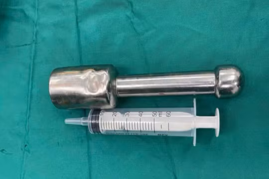 Bác sĩ gắp thành công chiếc chày kim loại 18cm mắc kẹt trong hậu môn thiếu niên 15 tuổi