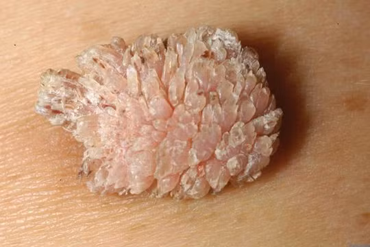 Chủ quan tự bôi thuốc, cụ ông gần 70 tuổi trả giá khi sùi mào gà lan kín vùng hậu môn