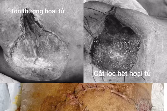Thanh niên 17 tuổi nguy kịch vì nhiễm khuẩn nặng từ một nốt mụn nhỏ