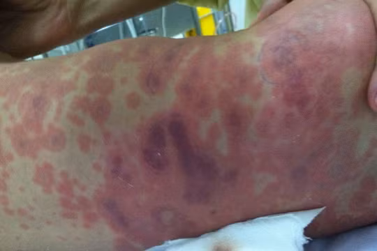 Xuất hiện 4 ca tử vong do não mô cầu, số mắc tăng so với cùng kỳ