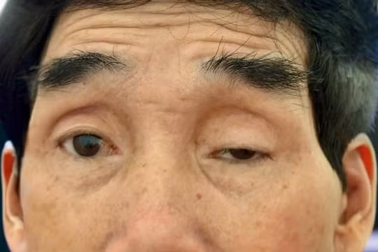 Suốt 65 năm sụp mí, lần đầu tiên bệnh nhân được mở trọn đôi mắt