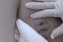 Cô gái gặp họa khi tiêm chất làm đầy nâng ngực trong khách sạn
