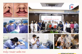 Bệnh viện Đại học Y Hà Nội tổ chức phẫu thuật miễn phí sứt môi, hở hàm ếch cho trẻ em