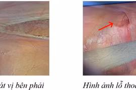 Thoát vị bẹn: Nữ giới gặp dễ rơi vào trường hợp bất thường giới tính