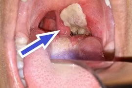 3 bệnh nhân tử vong do mắc bệnh bạch hầu: Bộ  Y tế chỉ đạo khẩn