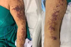 Nhiễm liên cầu lợn sau bữa ăn cùng với gia đình