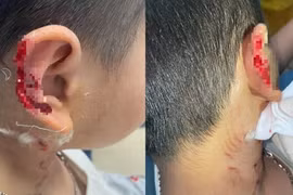 Bị chó lạ Phú Quốc vồ cắn, tai bé trai thương tích biến dạng