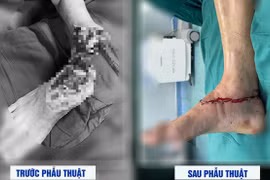 Đi cắt cỏ, người đàn ông bị máy cắt lìa cổ chân phải