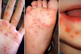 Thông tin thiếu thuốc điều trị bệnh tay chân miệng, Bộ Y tế nói gì?