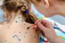 Bệnh thủy đậu vào mùa, lây lan mạnh tại Hà Nội