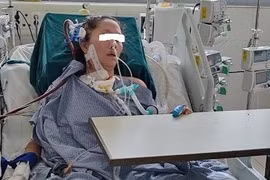 Lạm dụng corticoid tự điều trị cúm, bệnh nhân viêm phổi bội nhiễm rất nặng