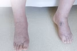 Bị phù chân, khó thở vì sử dụng thực phẩm chức năng “nhập ngoại” có chứa Corticoid