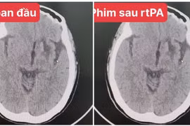 Bệnh nhân bị nhồi máu não lần đầu được cứu bằng cách rất đặc biệt