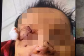 Cháu bé sơ sinh nghi bị chuột cắn vùng mặt