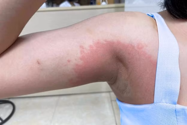 nguoi phu nu bi boi nhiem sau lieu trinh tay trang nach 40 trieu dong hinh 1