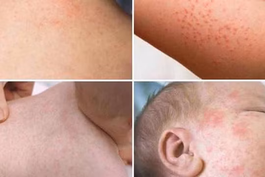 TP.HCM tiếp tục tăng cường phòng chống bệnh sởi