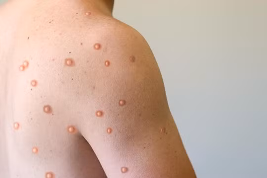 Kiên Giang đã ghi nhận 3 trường hợp mắc bệnh đậu mùa khỉ