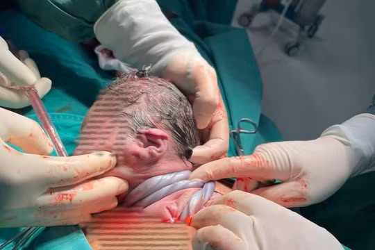 Suy thai ở tuần 39, mẹ con sản phụ may mắn được bác sĩ cứu sống