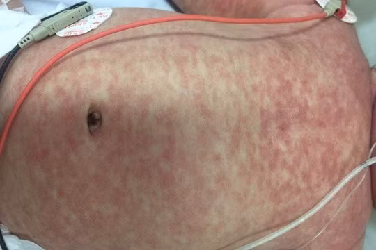 Hà Nam: Chủ động phòng chống bệnh Sởi/Rubella, giảm thiểu nguy cơ bùng phát dịch