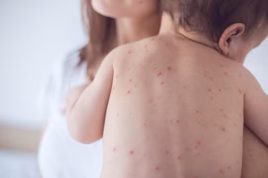 Bộ Y tế: Chủ động đưa trẻ từ 9 tháng đến 2 tuổi tiêm đủ vắc xin sởi